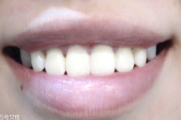 美牙仪可以天天用吗 牙齿美白要谨慎 美牙仪可以天天用吗 牙齿美白要谨慎